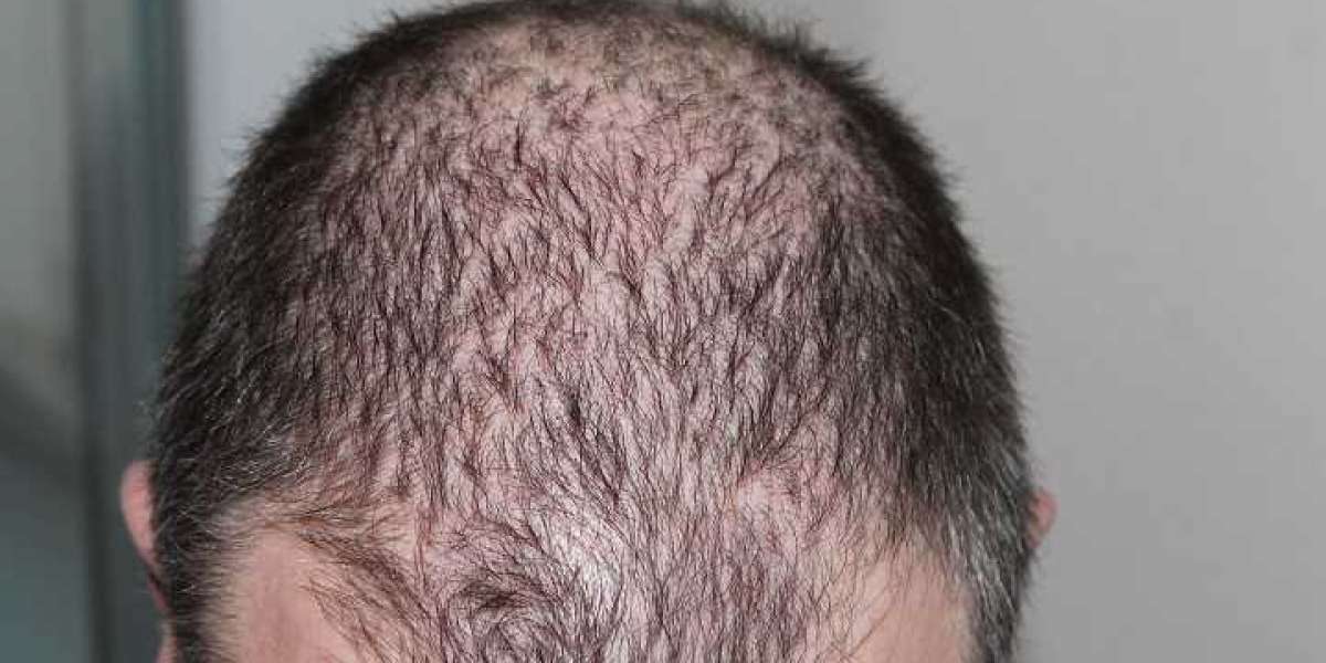 Locks of Legends: Mastering the Art of Hair Growth Oil For Men