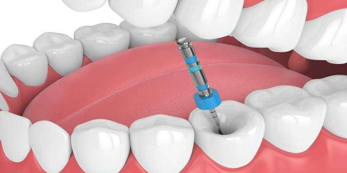 Endodontic Consumables Market: Information, Figures and Analytical Insights by 2031