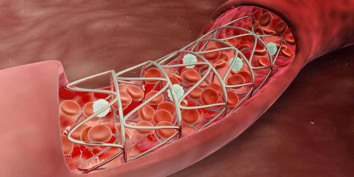 Coronary Stents Market Size, Share, Trends and Developments